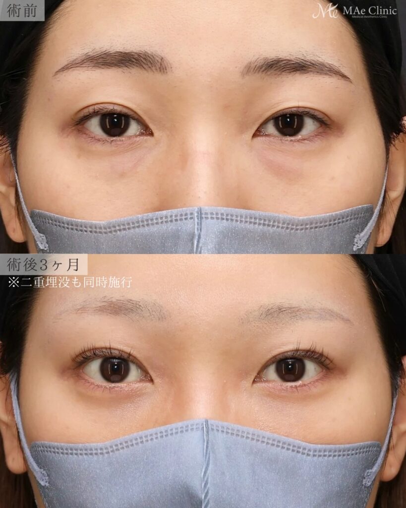 裏ハムラ法 (眼窩脂肪移動術・経結膜的眼窩脂肪移動術)前之園健太医師症例