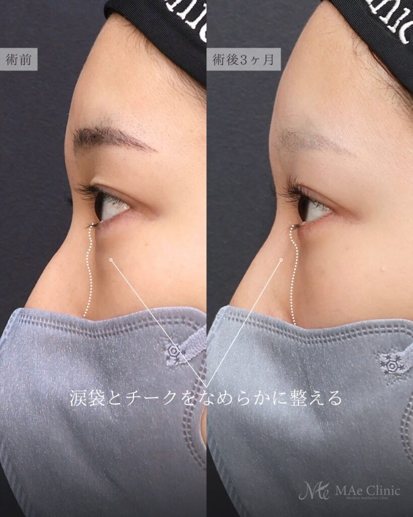 裏ハムラ法 (眼窩脂肪移動術・経結膜的眼窩脂肪移動術)前之園健太医師症例