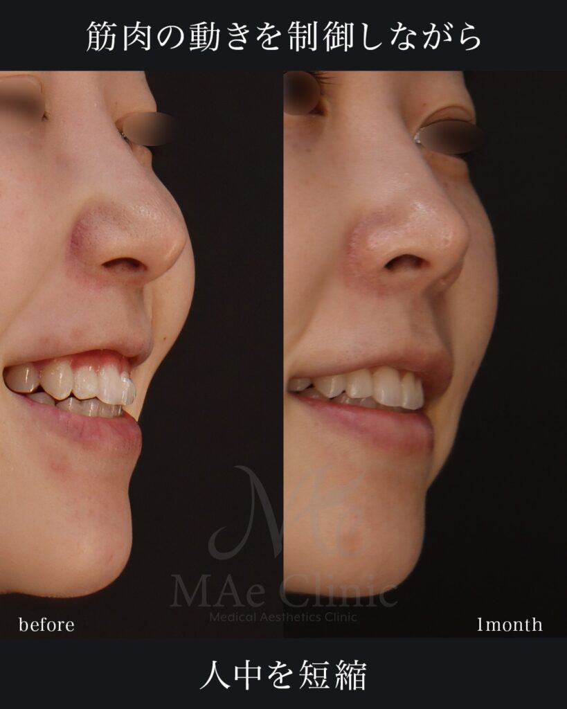 裏人中短縮 3D厚み調整 前田翔医師症例