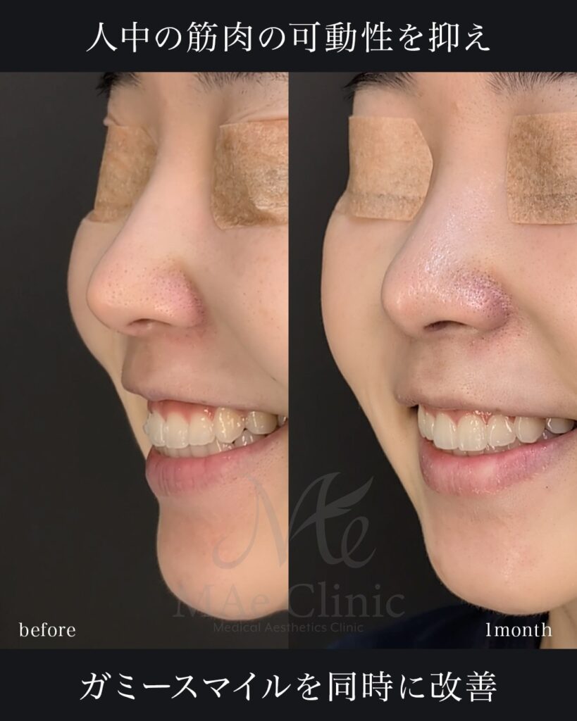 裏人中短縮 3D厚み調整 前田翔医師症例