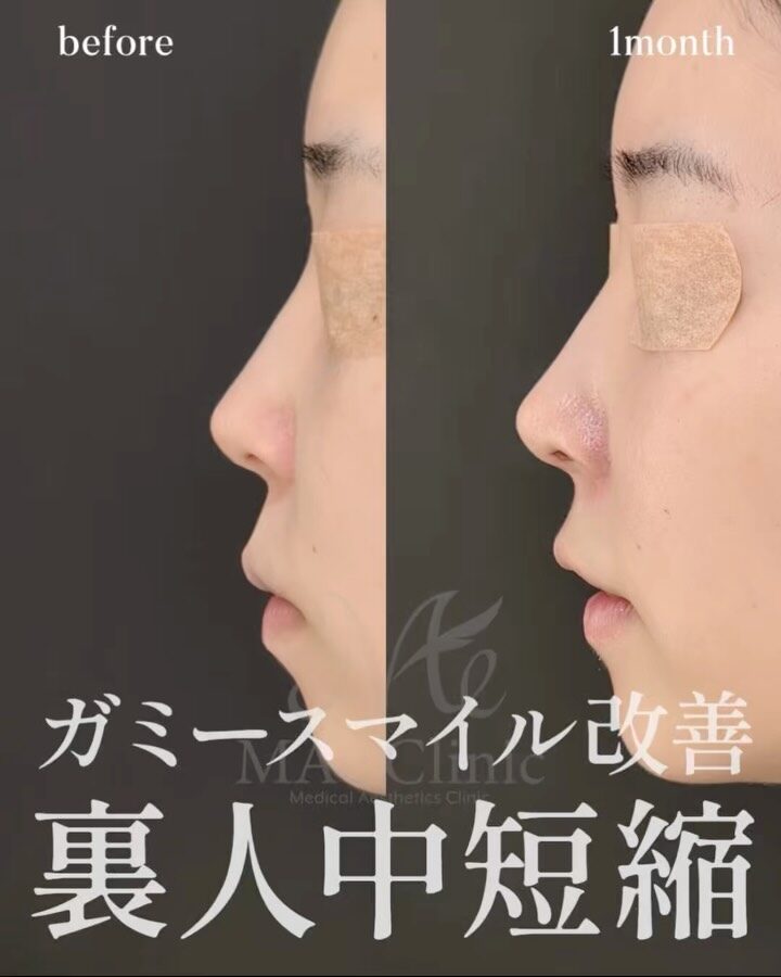 裏人中短縮 3D厚み調整 前田翔医師症例