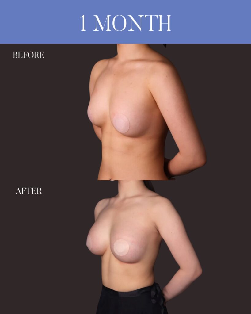 シリコンバック豊胸 （Motiva Ergonomix2：右250cc / 左200cc） アプローチ：乳房下溝切開 留置層：乳腺下　木下恵里沙医師症例