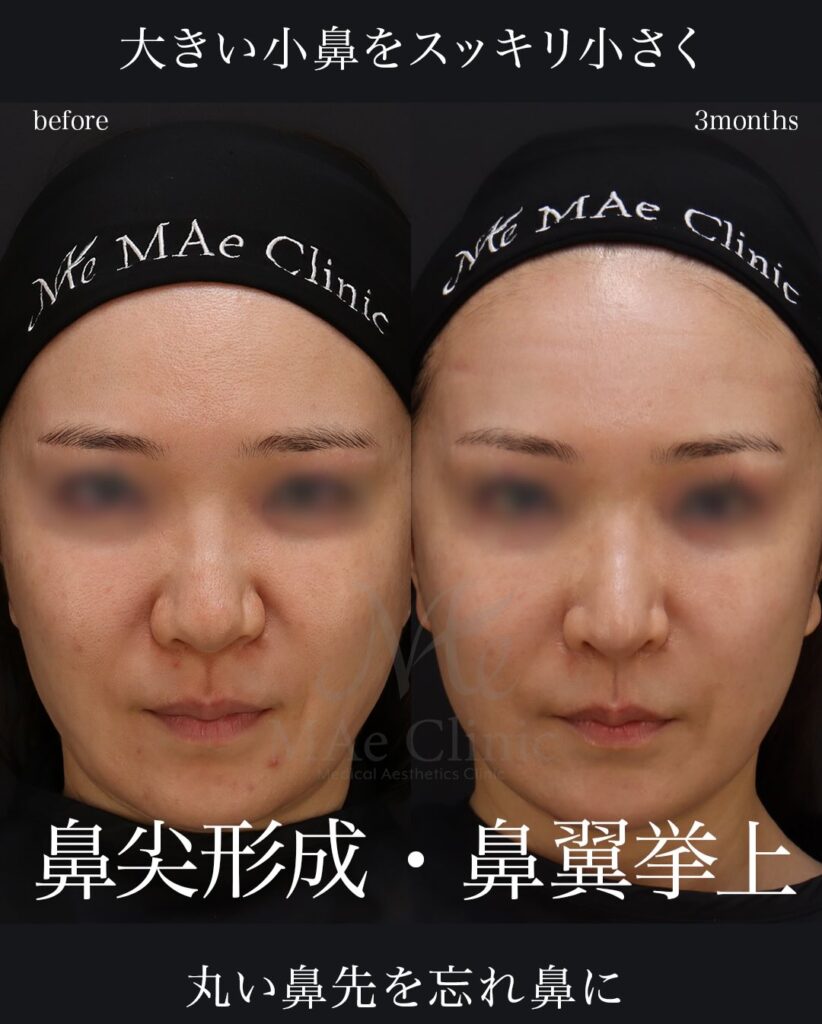 鼻尖形成 鼻翼挙上 望月正人医師症例