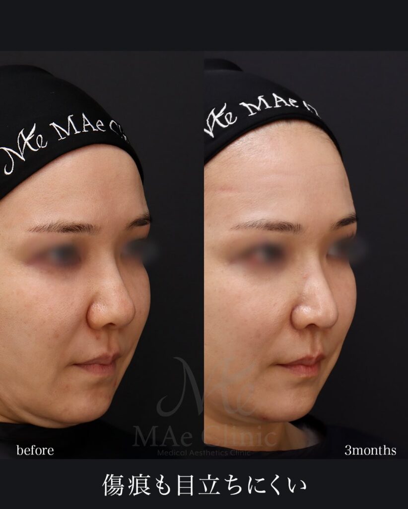 鼻尖形成 鼻翼挙上 望月正人医師症例