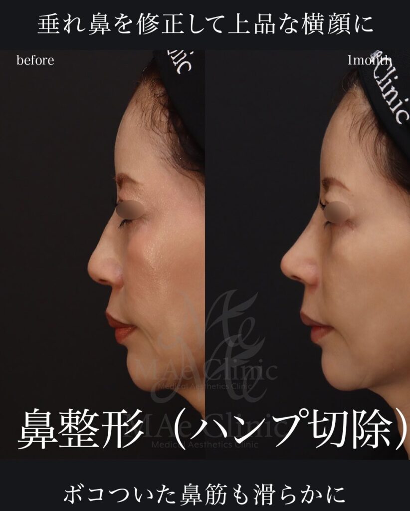 鼻中隔延長(肋軟骨) 鼻尖形成 鼻尖軟骨移植 小鼻縮小 ハンプ切除(+骨切り幅寄せ)望月正人医師症例