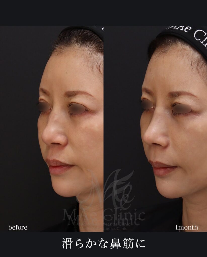 鼻中隔延長(肋軟骨) 鼻尖形成 鼻尖軟骨移植 小鼻縮小 ハンプ切除(+骨切り幅寄せ)望月正人医師症例