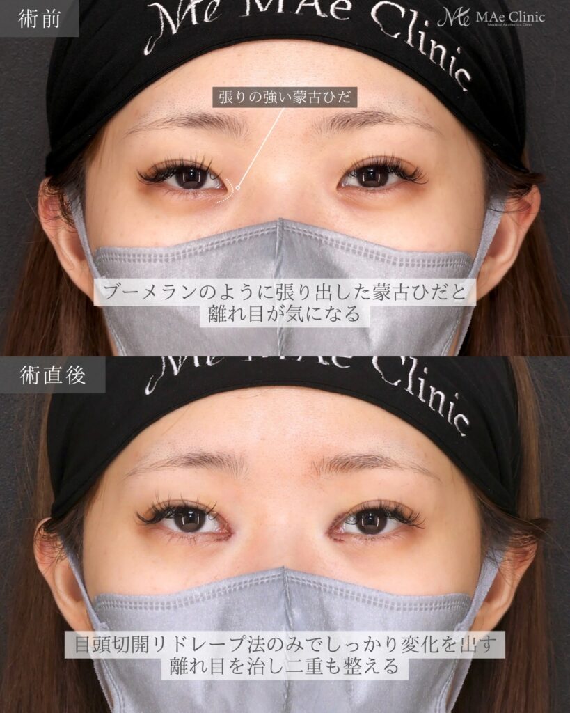 目頭切開 (リドレープ法)前之園健太医師症例