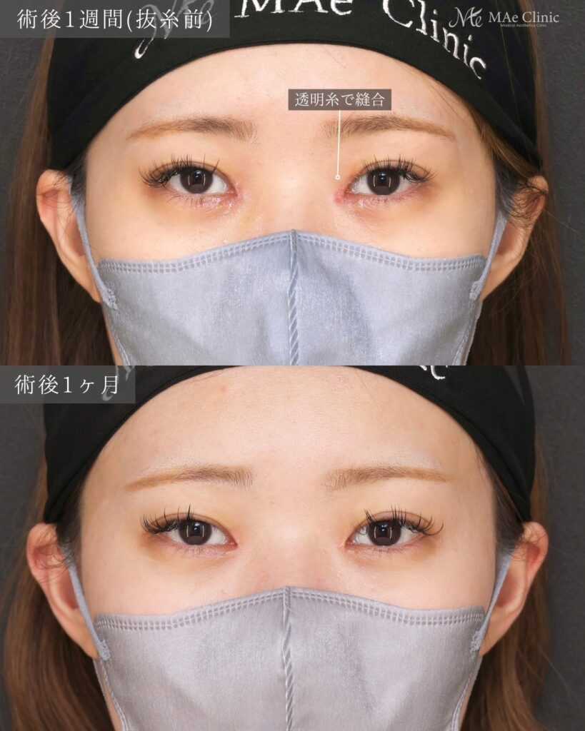 目頭切開 (リドレープ法)前之園健太医師症例