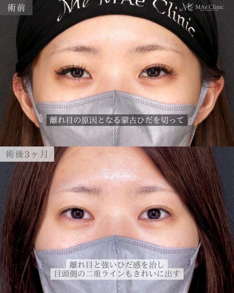 目頭切開 (リドレープ法)前之園健太医師症例