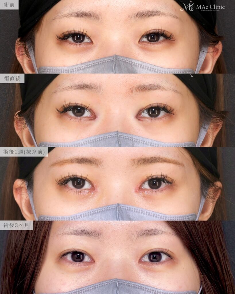 目頭切開 (リドレープ法)前之園健太医師症例