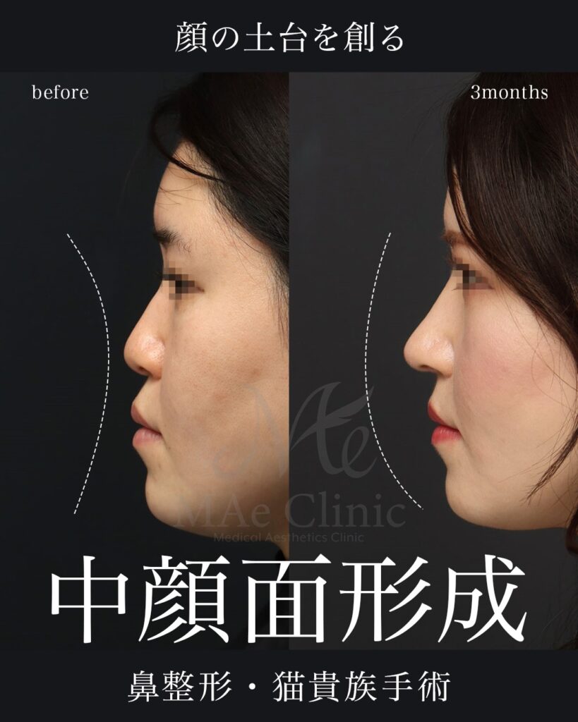 鼻中隔延長（肋軟骨） 鼻尖形成 梨状口縁細片軟骨移植（猫貴族手術・肋軟骨） 鼻背細片軟骨移植（隆鼻術・肋軟骨） ※全て自家組織のみ使用 前田翔医師症例