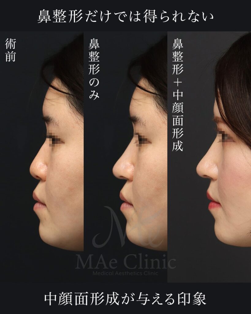 鼻中隔延長(肋軟骨) 鼻尖形成 梨状口縁細片軟骨移植(猫貴族手術・肋軟骨) 鼻背細片軟骨移植(隆鼻術・肋軟骨) ※全て自家組織のみ使用 前田翔医師症例