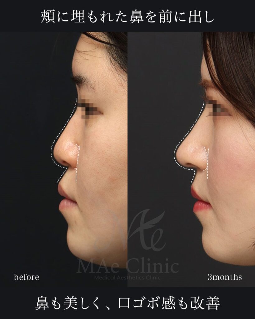 鼻中隔延長(肋軟骨) 鼻尖形成 梨状口縁細片軟骨移植(猫貴族手術・肋軟骨) 鼻背細片軟骨移植(隆鼻術・肋軟骨) ※全て自家組織のみ使用 前田翔医師症例