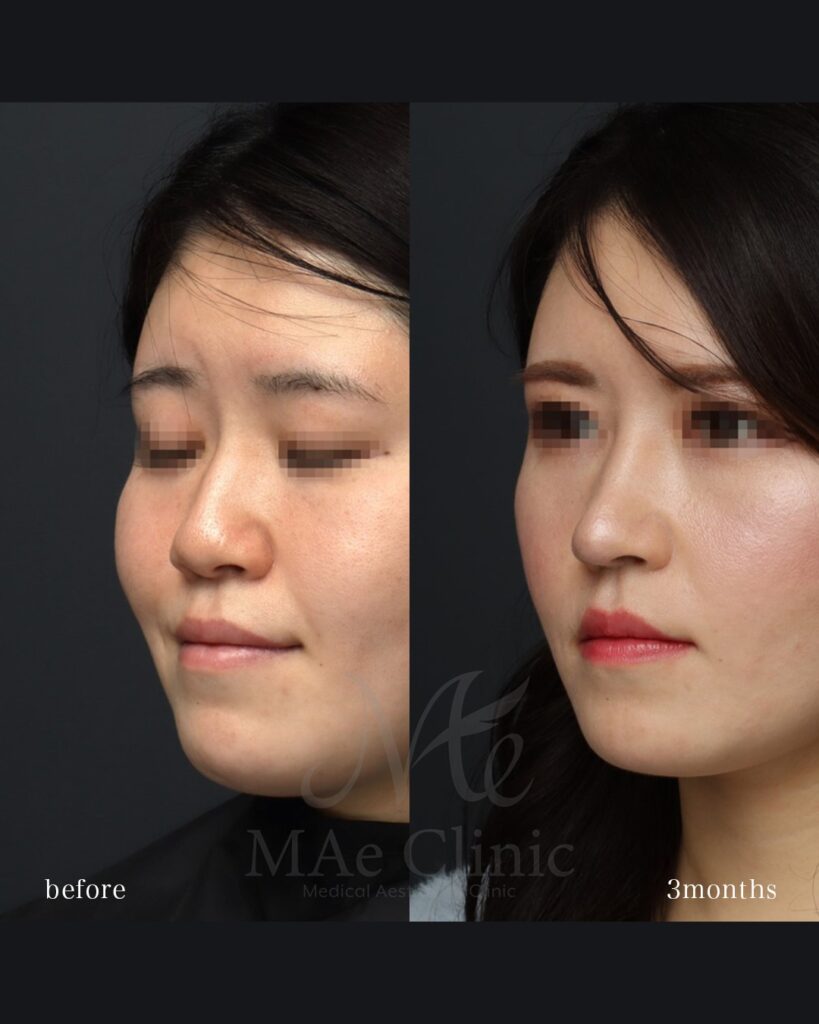 鼻中隔延長(肋軟骨) 鼻尖形成 梨状口縁細片軟骨移植(猫貴族手術・肋軟骨) 鼻背細片軟骨移植(隆鼻術・肋軟骨) ※全て自家組織のみ使用 前田翔医師症例