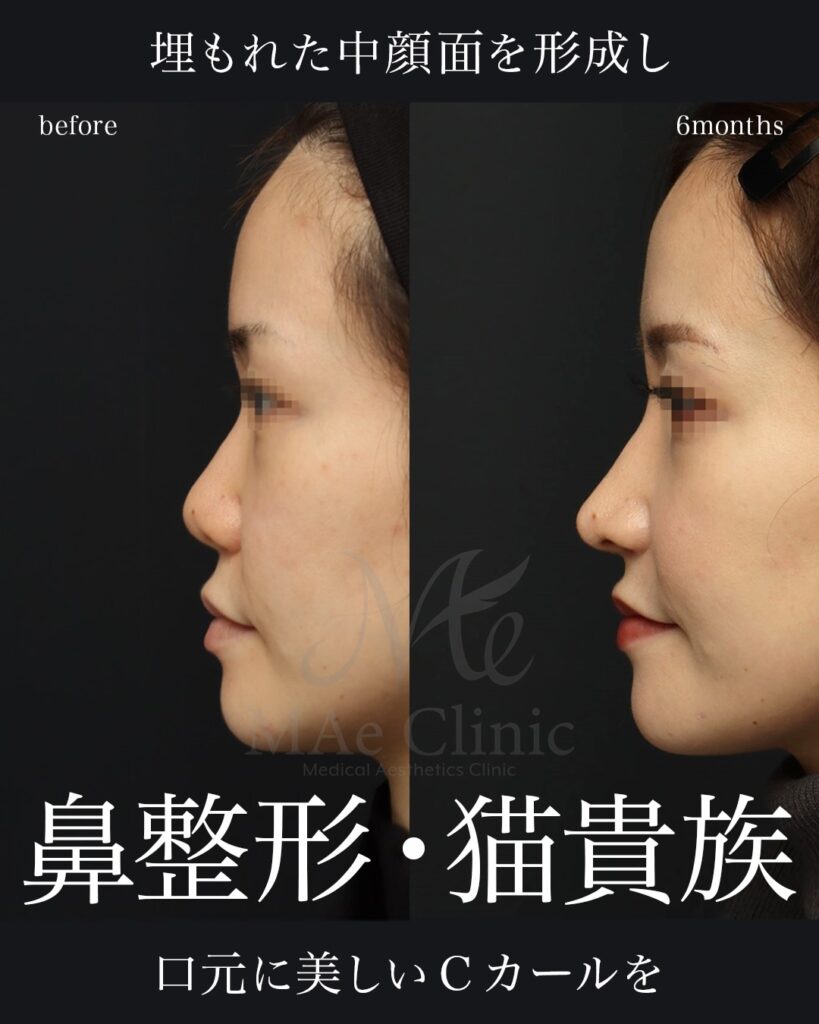 鼻中隔延長（肋軟骨） 鼻尖形成 梨状口縁細片軟骨移植（猫貴族手術・肋軟骨） 鼻背細片軟骨移植（隆鼻術・肋軟骨） ※全て自家組織のみ使用　前田翔医師症例