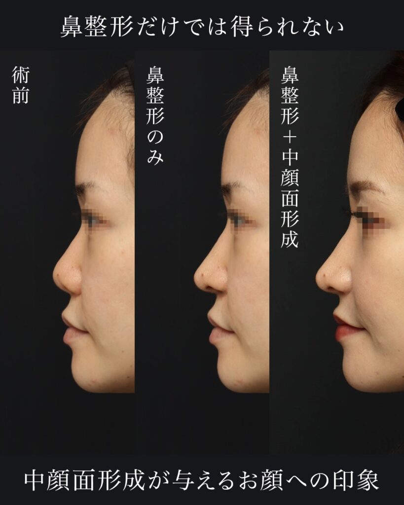 鼻中隔延長（肋軟骨） 鼻尖形成 梨状口縁細片軟骨移植（猫貴族手術・肋軟骨） 鼻背細片軟骨移植（隆鼻術・肋軟骨） ※全て自家組織のみ使用　前田翔医師症例