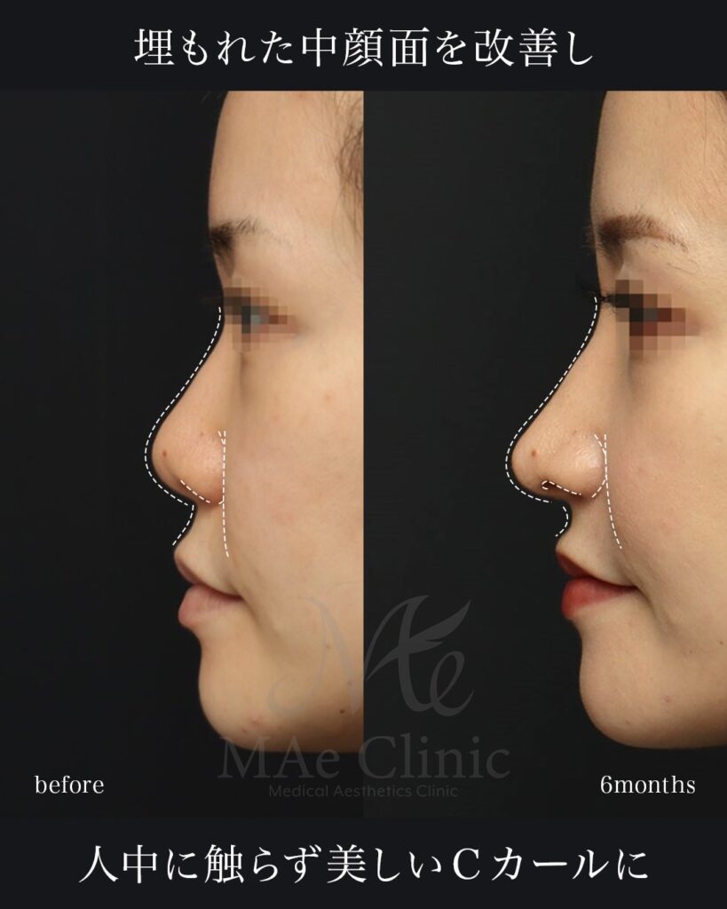 鼻中隔延長（肋軟骨） 鼻尖形成 梨状口縁細片軟骨移植（猫貴族手術・肋軟骨） 鼻背細片軟骨移植（隆鼻術・肋軟骨） ※全て自家組織のみ使用　前田翔医師症例