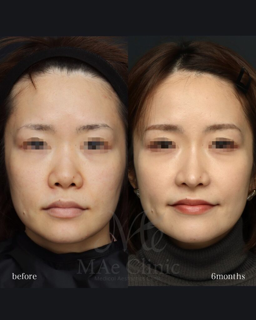 鼻中隔延長（肋軟骨） 鼻尖形成 梨状口縁細片軟骨移植（猫貴族手術・肋軟骨） 鼻背細片軟骨移植（隆鼻術・肋軟骨） ※全て自家組織のみ使用　前田翔医師症例