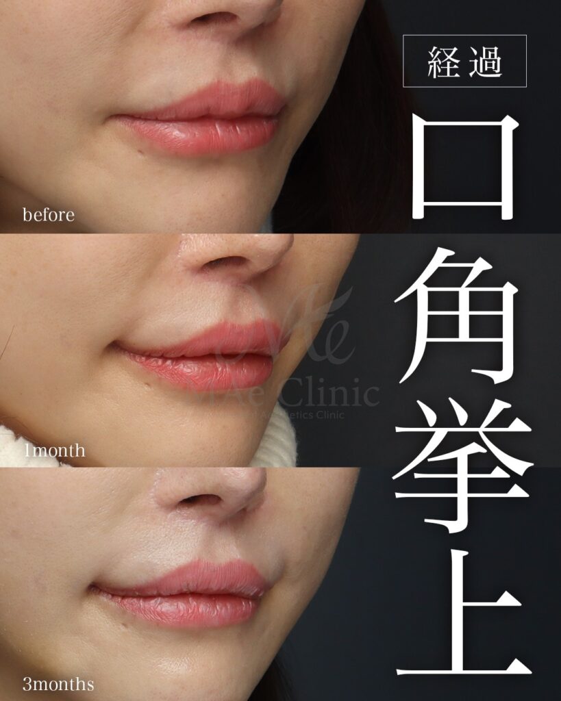 口角挙上 裏人中短縮（他院修正） 人中窩形成
前田翔医師症例