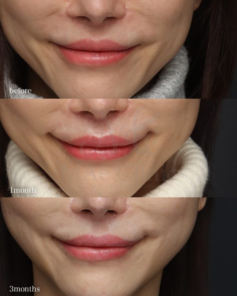 口角挙上 裏人中短縮（他院修正） 人中窩形成 前田翔医師症例