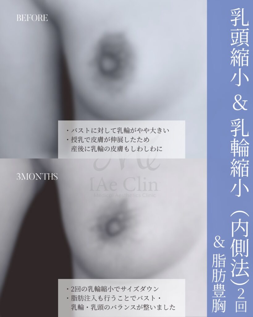 乳頭縮小術 乳輪縮小術 脂肪注入豊胸 ※3つの施術を同時に実施 木下恵里沙医師症例