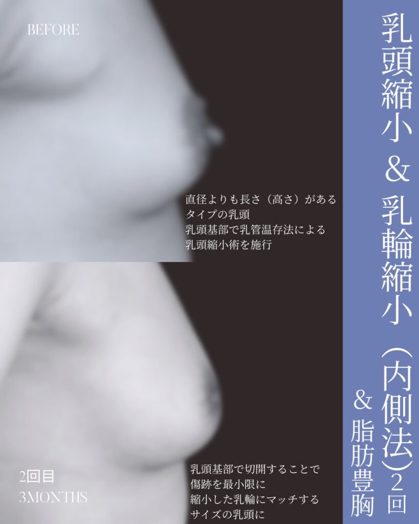 乳頭縮小術 乳輪縮小術 脂肪注入豊胸 ※3つの施術を同時に実施 木下恵里沙医師症例
