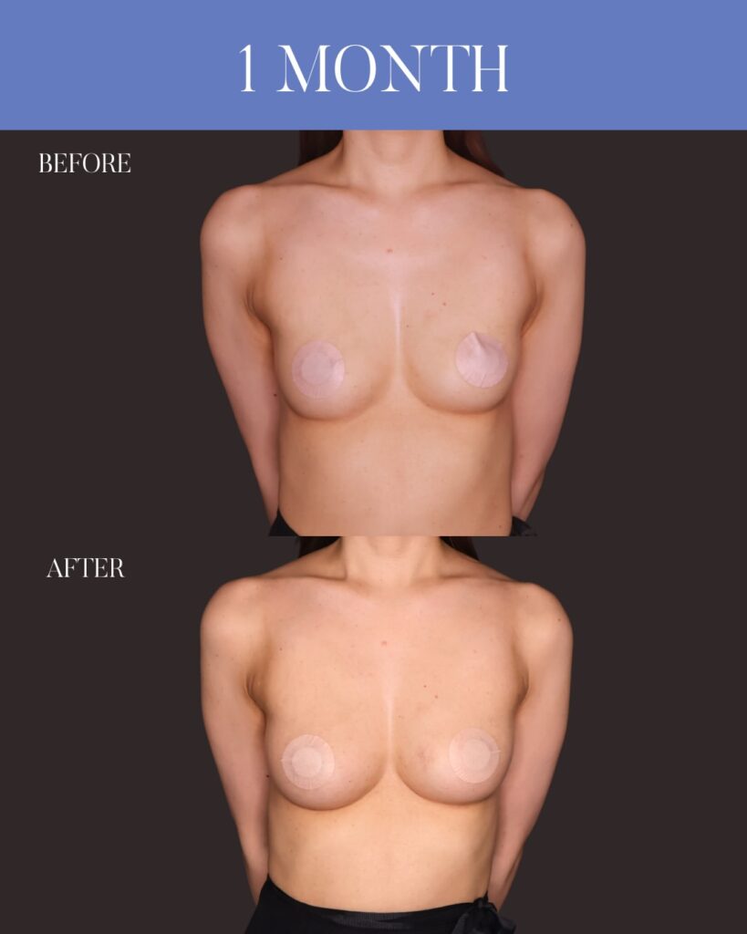 コンデンスリッチ脂肪注入豊胸 採取：大腿前面 注入量：右250ml・左220ml
木下恵里沙医師症例