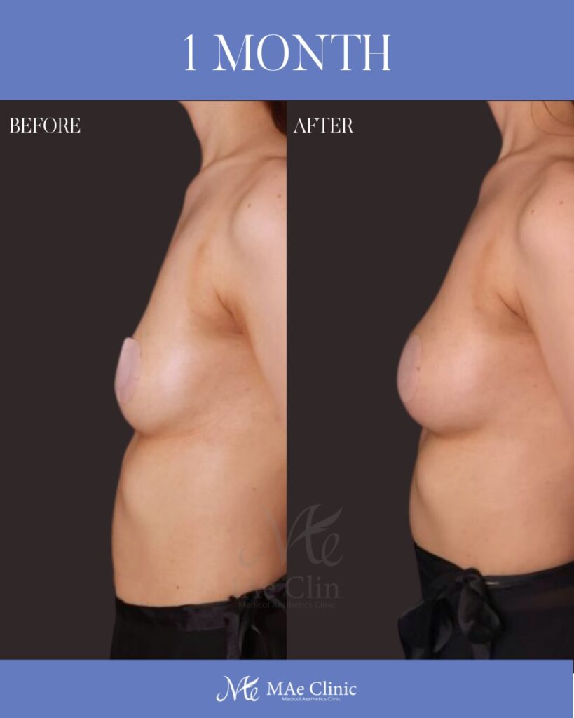 コンデンスリッチ脂肪注入豊胸 採取：大腿前面 注入量：右250ml・左220ml 木下恵里沙医師症例