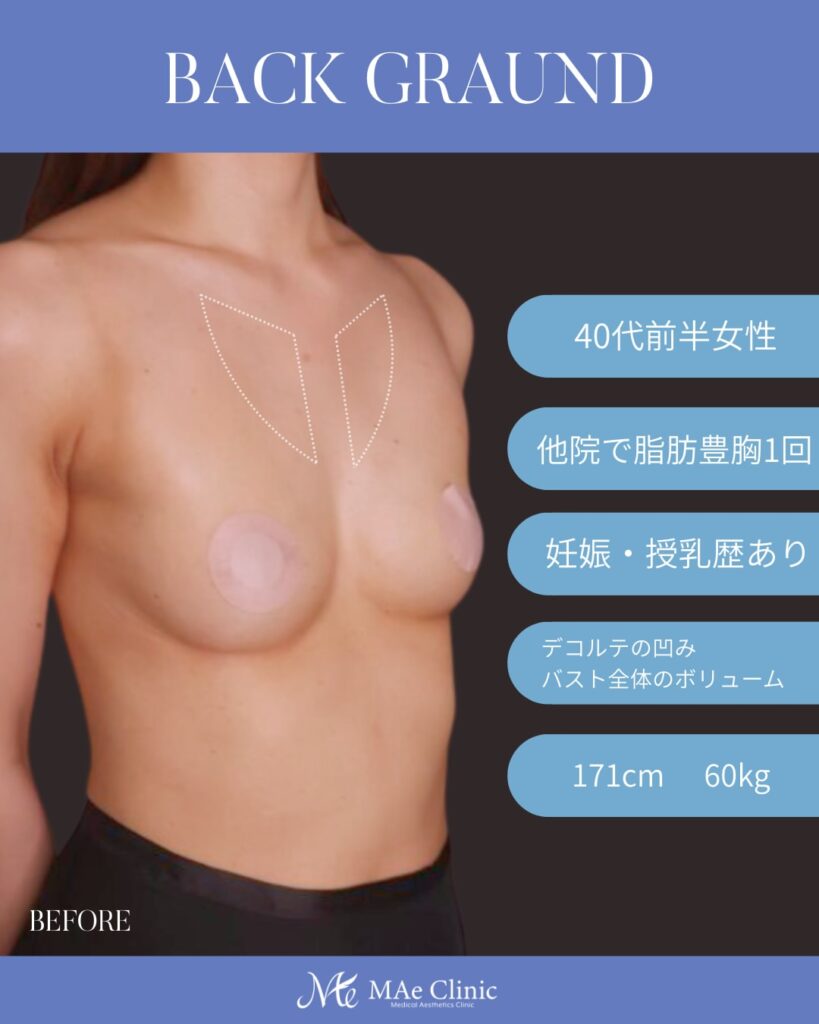 コンデンスリッチ脂肪注入豊胸 採取：大腿前面 注入量：右250ml・左220ml 木下恵里沙医師症例