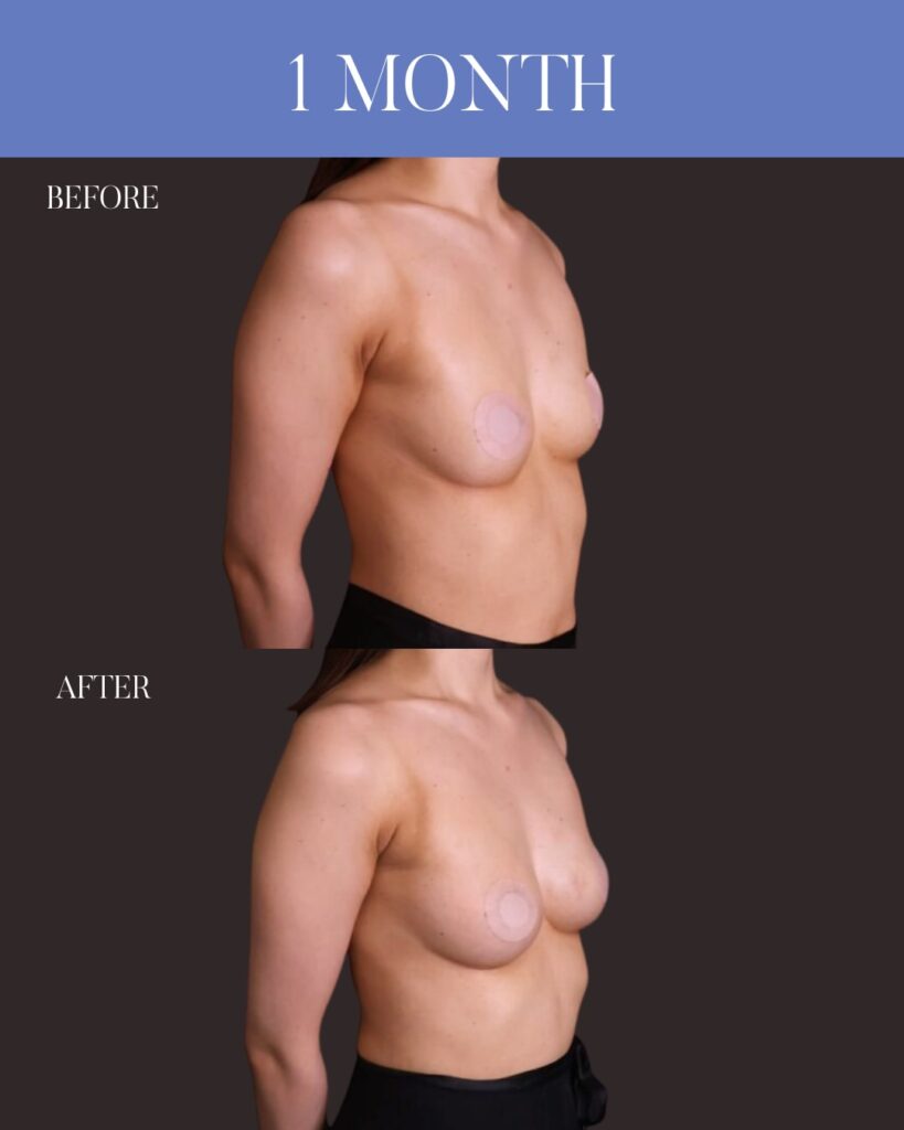 コンデンスリッチ脂肪注入豊胸 採取：大腿前面 注入量：右250ml・左220ml 木下恵里沙医師症例