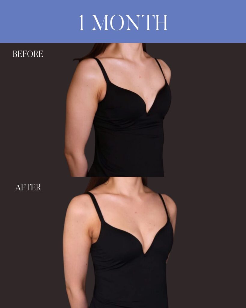 コンデンスリッチ脂肪注入豊胸 採取：大腿前面 注入量：右250ml・左220ml 木下恵里沙医師症例