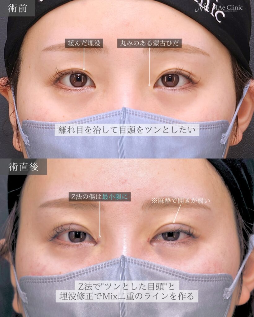 目頭切開（Z法） 二重埋没法（裏留め）前之園健太医師症例