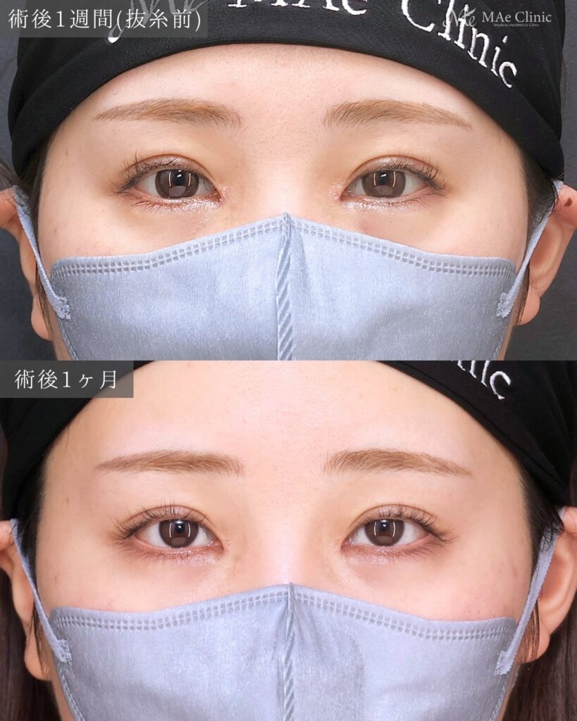 目頭切開（Z法） 二重埋没法（裏留め）前之園健太医師症例