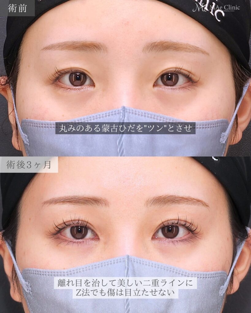 目頭切開（Z法） 二重埋没法（裏留め）前之園健太医師症例