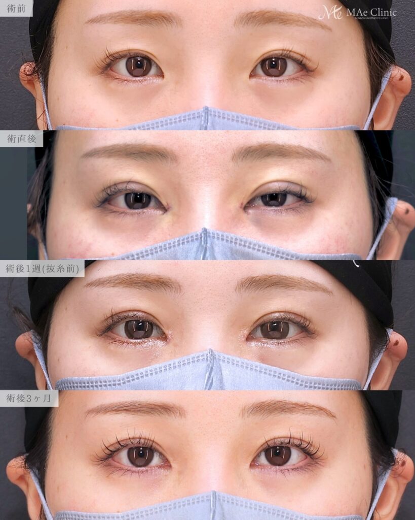 目頭切開（Z法） 二重埋没法（裏留め）前之園健太医師症例