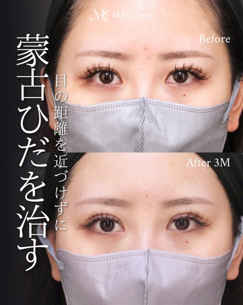 目頭切開（リドレープ法）前之園健太医師症例