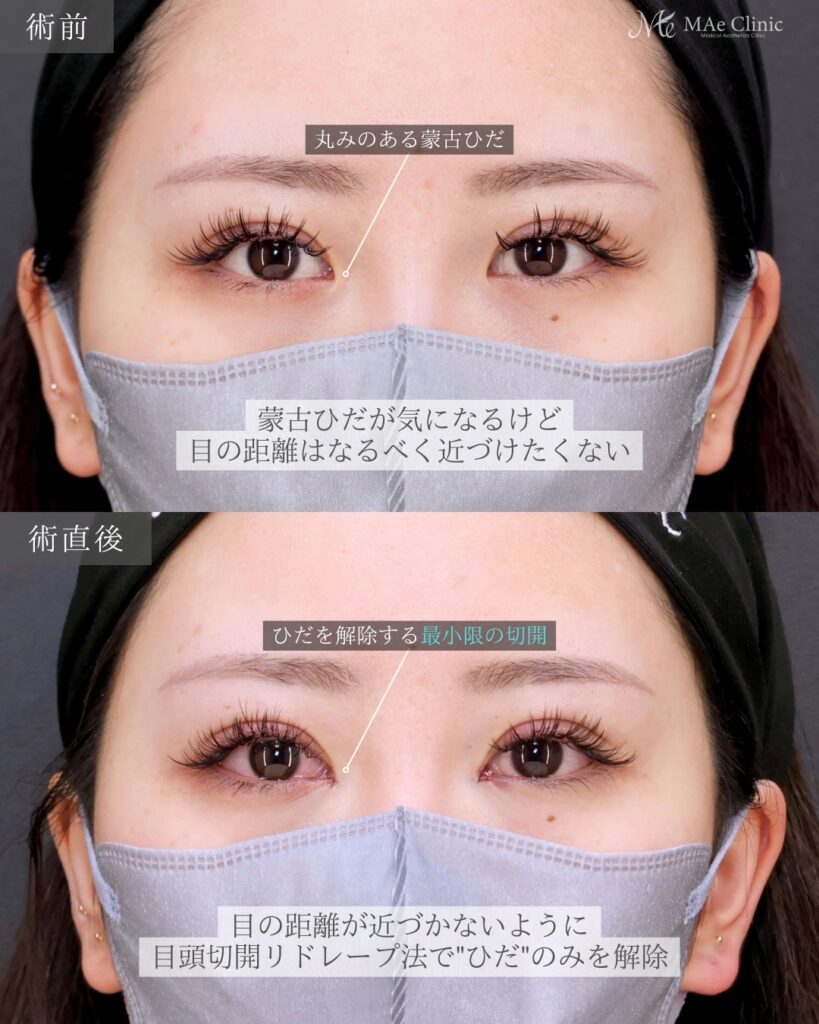 目頭切開（リドレープ法）前之園健太医師症例