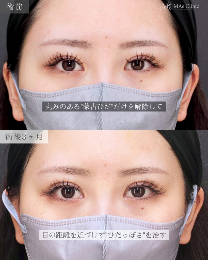 目頭切開（リドレープ法）前之園健太医師症例