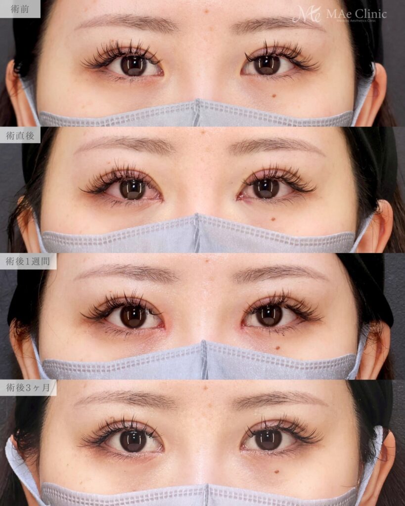 目頭切開（リドレープ法）前之園健太医師症例