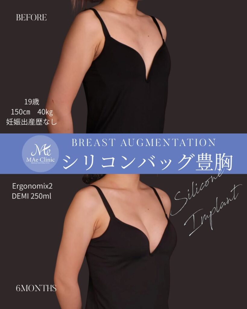 シリコンバッグ豊胸 使用バッグ：Motiva Ergonomix2（モティバ エルゴノミクス2） サイズ：250ml 木下恵里沙医師症例