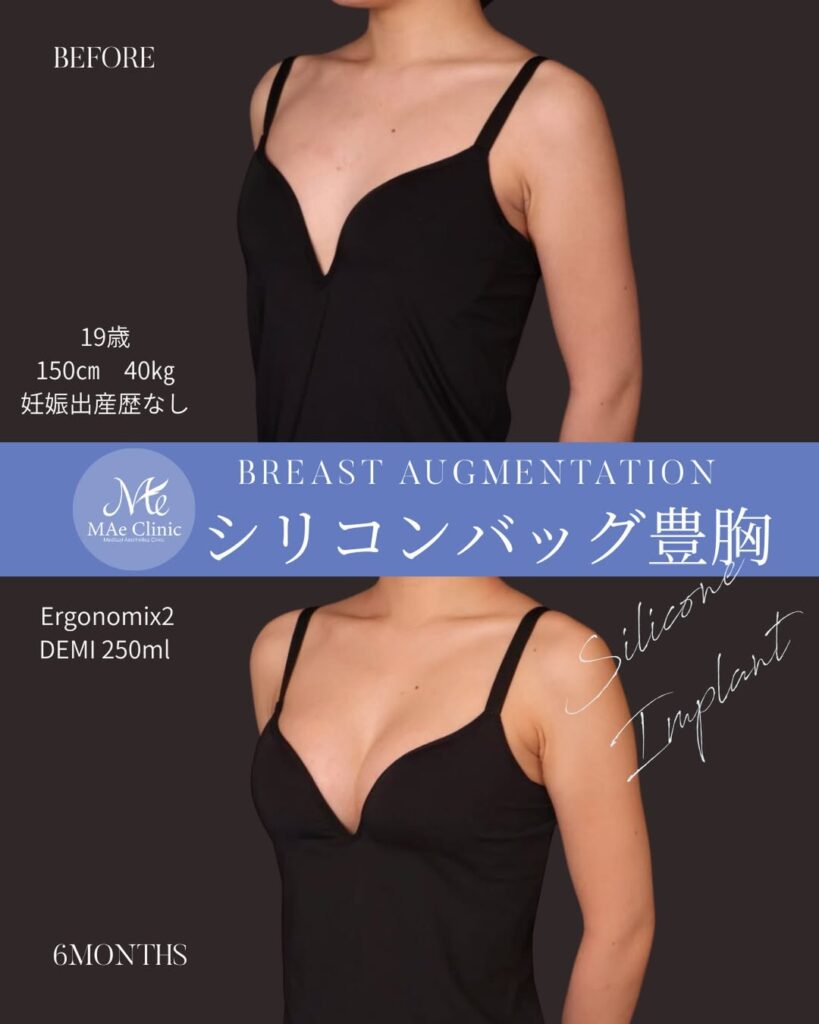 シリコンバッグ豊胸 使用バッグ：Motiva Ergonomix2（モティバ エルゴノミクス2） サイズ：250ml 木下恵里沙医師症例