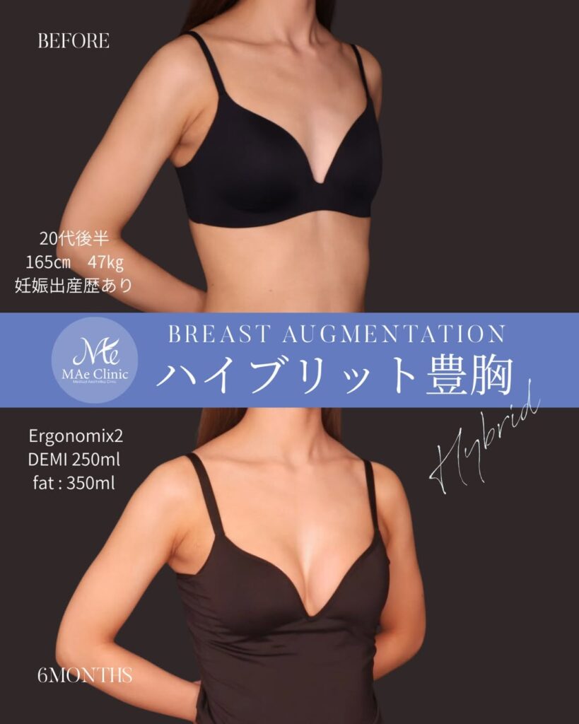 ハイブリッド豊胸 シリコンバッグ：Motiva Ergonomix2（モティバ エルゴノミクス2）250ml 脂肪注入：計350ml（片側175mlずつ）
木下恵里沙医師症例