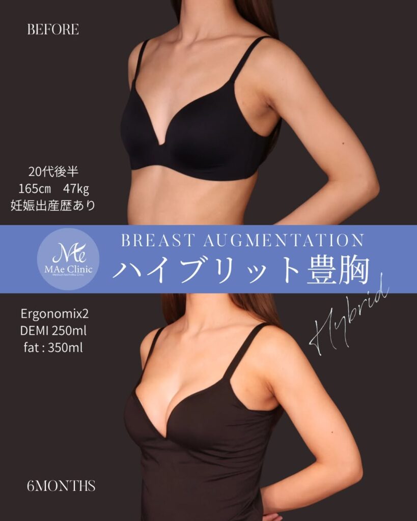 ハイブリッド豊胸 シリコンバッグ：Motiva Ergonomix2（モティバ エルゴノミクス2）250ml 脂肪注入：計350ml（片側175mlずつ） 木下恵里沙医師症例