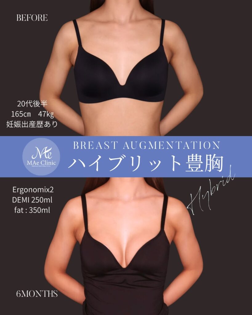 ハイブリッド豊胸 シリコンバッグ：Motiva Ergonomix2（モティバ エルゴノミクス2）250ml 脂肪注入：計350ml（片側175mlずつ） 木下恵里沙医師症例