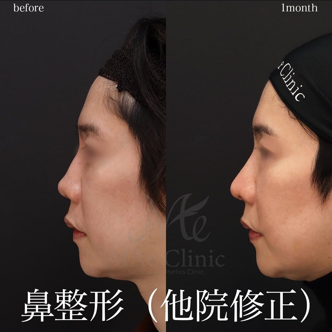 鼻中隔湾曲症の手術後に低くなった鼻を修正。肋軟骨による鼻再建：望月