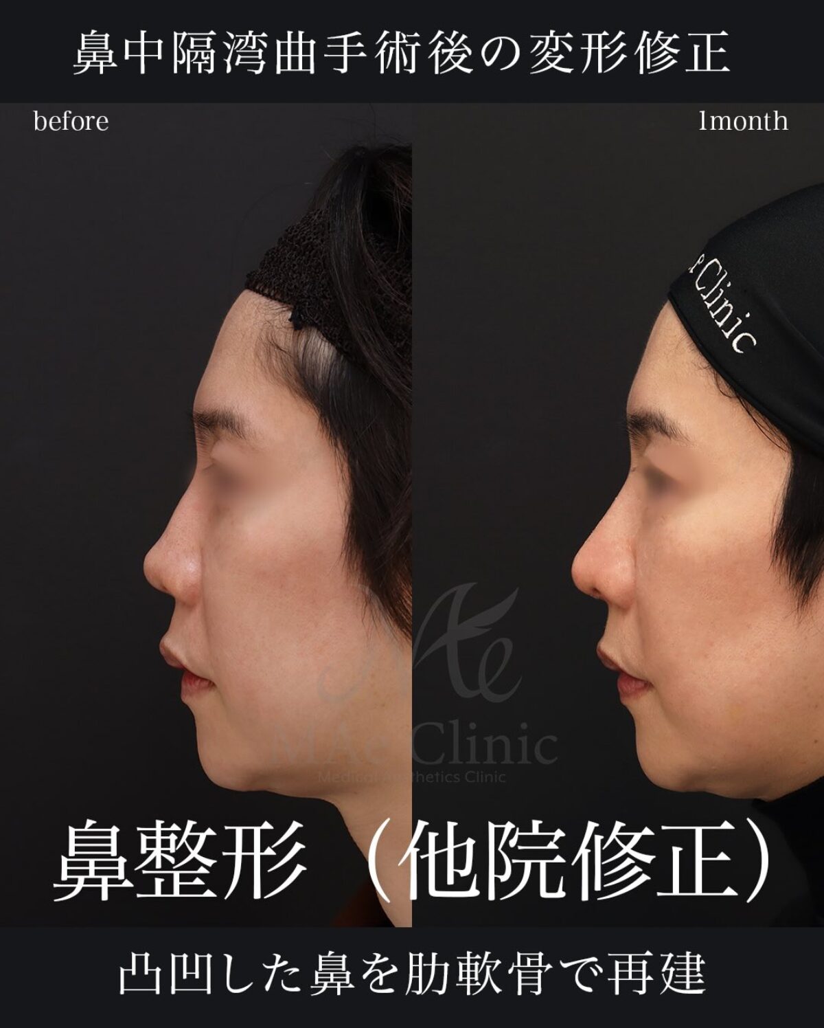 鼻中隔湾曲症の手術後に低くなった鼻を修正。肋軟骨による鼻再建：望月