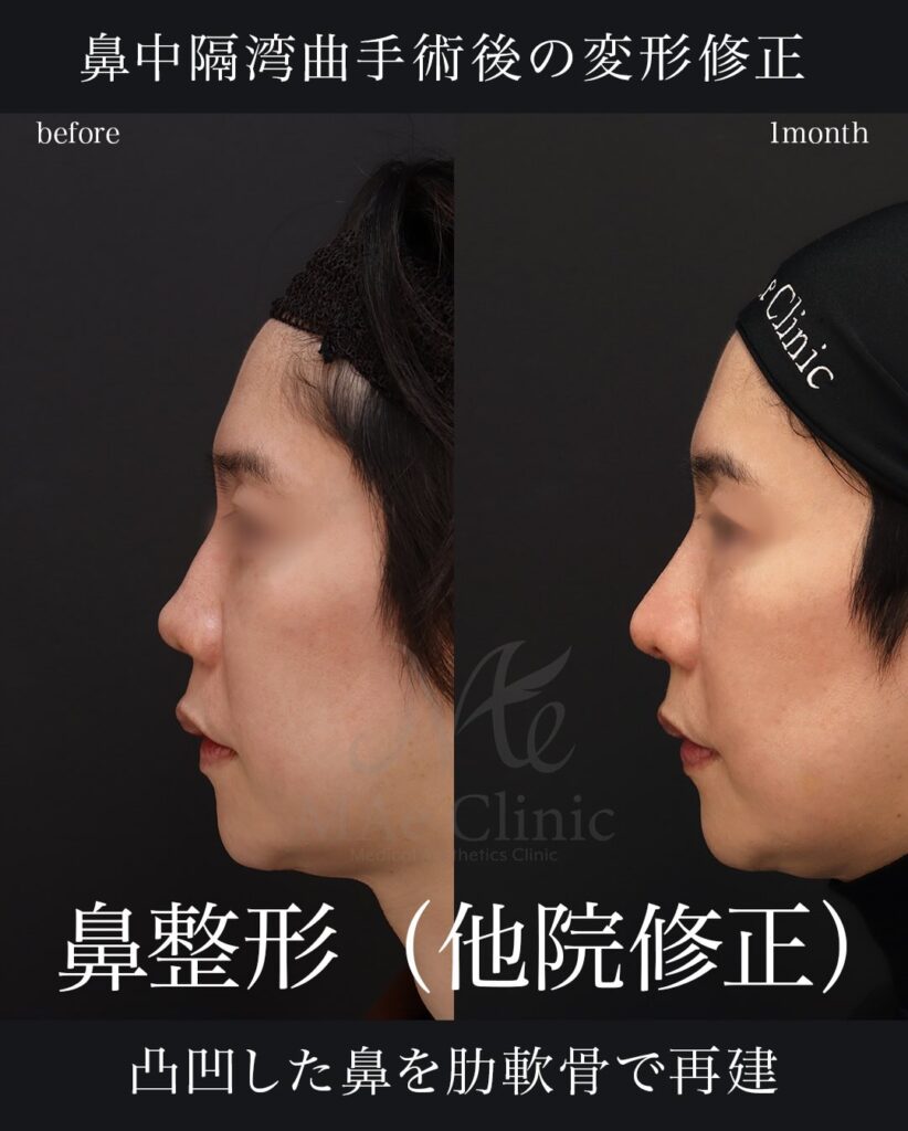 鼻中隔延長（肋軟骨） 鼻尖形成 鼻尖軟骨移植 他院修正
望月正人医師症例