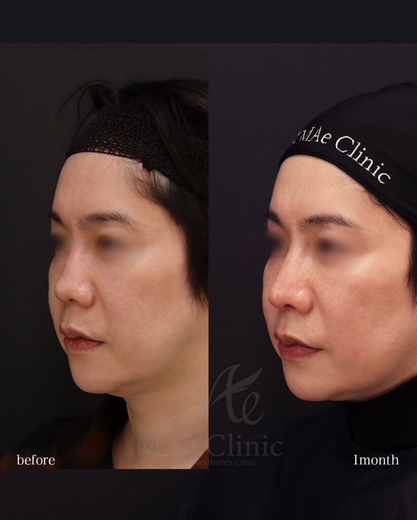 鼻中隔延長（肋軟骨） 鼻尖形成 鼻尖軟骨移植 他院修正 望月正人医師症例