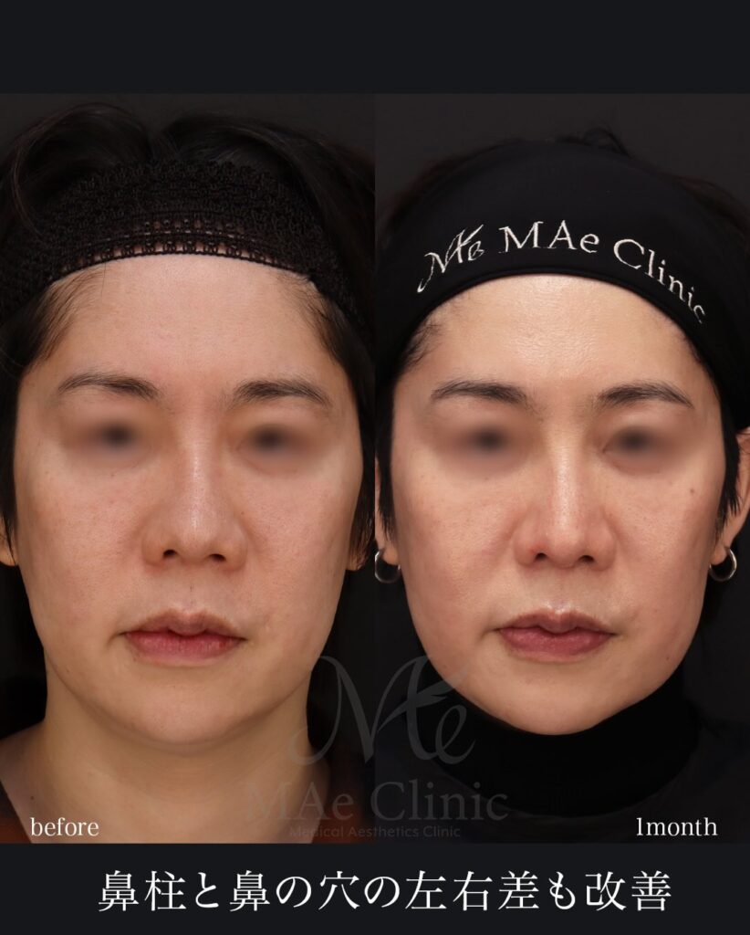 鼻中隔延長（肋軟骨） 鼻尖形成 鼻尖軟骨移植 他院修正 望月正人医師症例