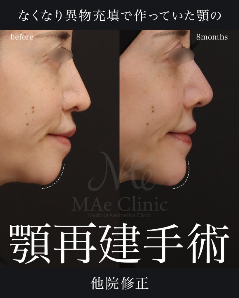 Vライン修正（顎先再建・肋軟骨移植）
鼻中隔延長（肋軟骨）
鼻尖形成・鼻尖軟骨移植
隆鼻術（肋軟骨）
猫貴族手術 
前田翔医師症例